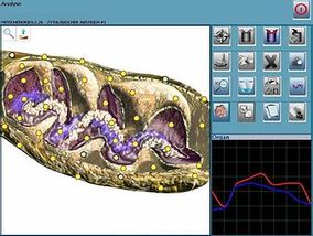  UDCM Ursachen Diagnostik