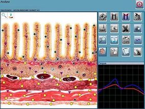 UDCM Ursachen Diagnostik
